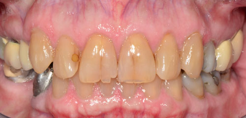 patient's teeth before treatment