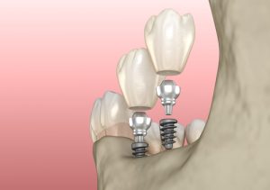 mini dental implants