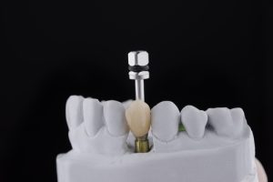 single tooth implant