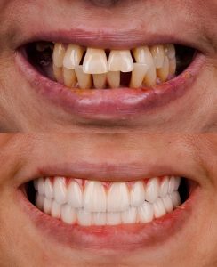 before and after veneers