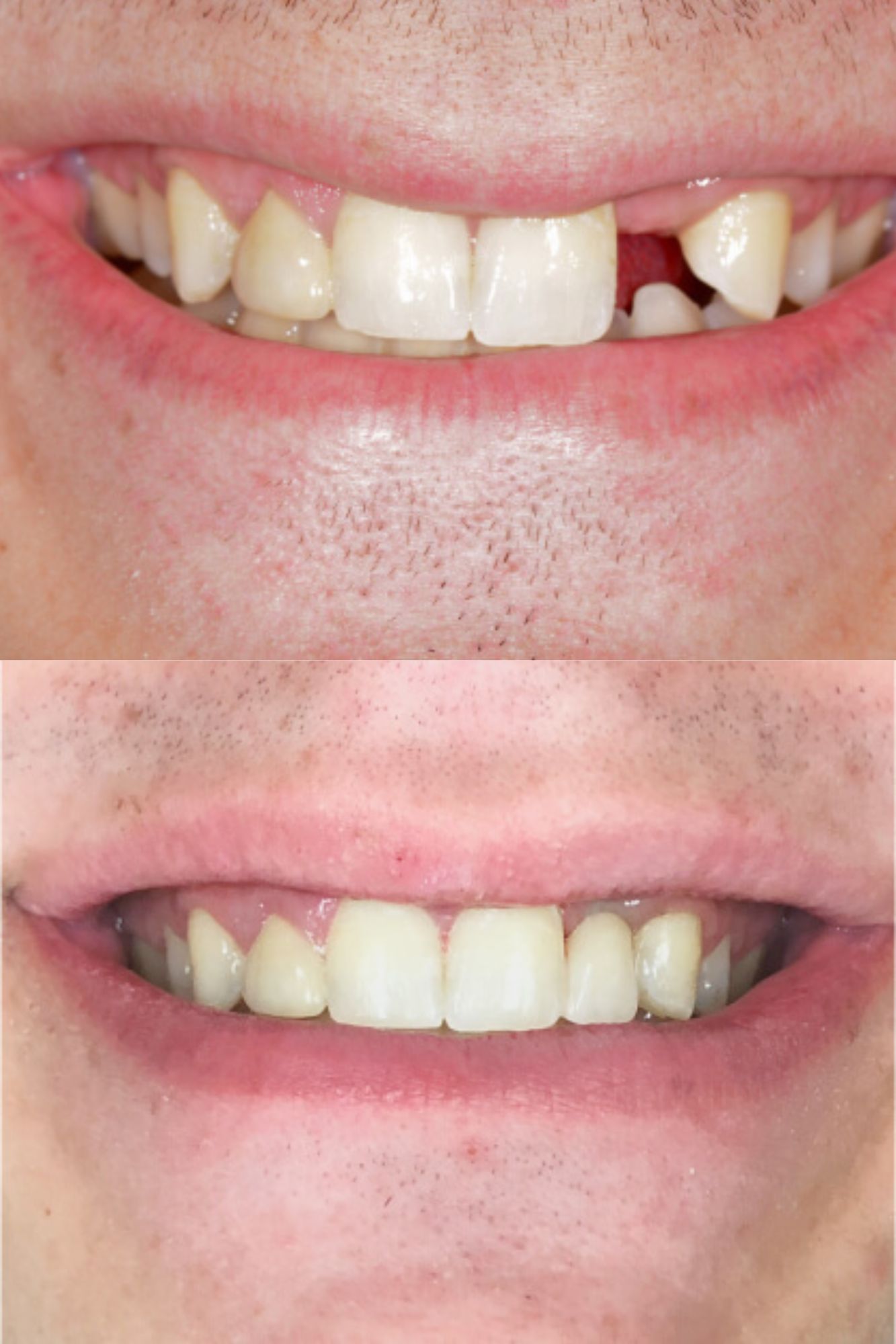 before and after a bonded bridge