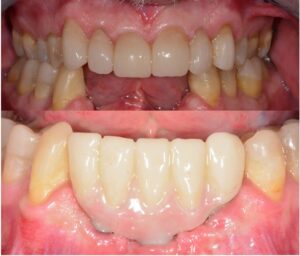 before and after lower anterior implant bridge