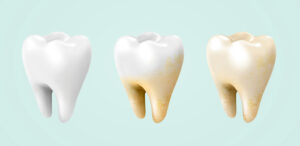 before and after whitening treatment